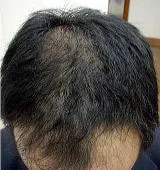 使用後(約6ヶ月後)