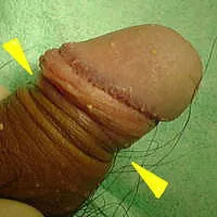 包皮輪の狭い仮性包茎