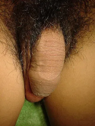 包茎手術直前の写真(正面)