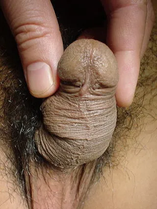 包茎手術直前の写真(包皮小帯側)