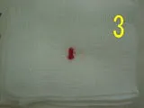 切断した右精管。残った精管は二重に縛ります